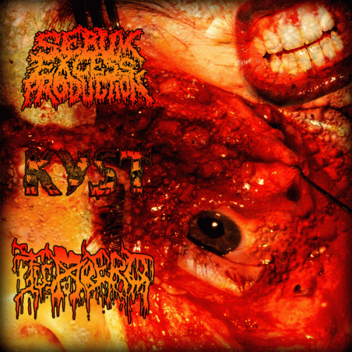 Sebum Excess Production : Sebum Excess Production - Kyst - Tumbero